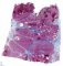 Mixed hepatoblastoma