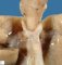 Right aortic arch and retroesophageal ductus arteriosus