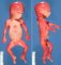 Thick neck in trisomy 21 (fetus 19 weeks)