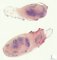 Nodular sclerosing Hodgkin lymphoma
