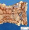 Crohn colitis