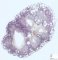 Fetal obstructive kidney 22 weeks
