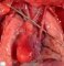 Persistent rignt superior vena cava in situs ambiguus