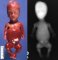 Thanatophoric dysplasia