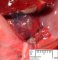 Renal hypodysplasia (Case #11194)