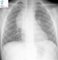 Mediastinal intermixed ganglioneuroblastoma