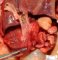 Duodenal dilatation in multiple intestinal atresia syndrome