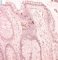 Adenoviral colonic infections