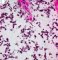 Botryoid embryonal rhabdomyosarcoma of the rhinopharynx