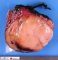 Clear cell sarcoma of the kidney