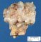 Femoral osteochondroma