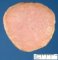 Necrobiotic subserosal uterine leiomyoma
