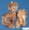 Plexiform neurofibroma in neurofibromatosis type 1 (NF1)