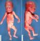 Potter facies in oligohydranios sequence (fetus, 22 weeks)