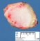 Nodular melanoma of the scalp
