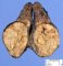 Thyroid papillary carcinoma