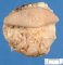 Lower limb lipoma