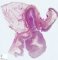 Meckel diverticula with ileal perforation