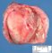 Ovarian mature teratoma