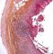 Acute appendicitis