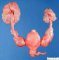 Bilateral hydronephrosis and bilateral megaureteres with posterior urethral (...)