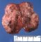 Cervical teratoma (21 weeks)