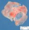 Pericentral diaphragmatic hypoplasia