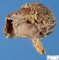 Abdominal cystic lymphangioma