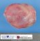 Alveolar rhabdomyosarcoma of limbs