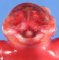 Anencephaly (fetus, 19 weeks)
