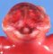 Anencephaly (fetus, 19 weeks)
