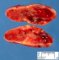 Cellular schwannoma