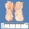 Fibrolipoma