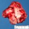 Infantile desmoplastic ganglioglioma