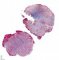 Intramuscular lobular capillary hemangioma