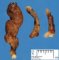 Juvenile polyposis