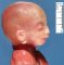 Micrognathia with retrognathia (fetus, 21 weeks)