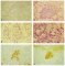 Microscopic medullary thyroid carcinoma (PMID:9630179)