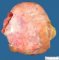 Ovarian thecoma