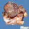 Cyst of the thyroglossal tract