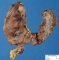Thyroid papillary carcinoma