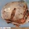 Torsion of an ovary with juvenile granulosa tumor