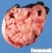 Sacrococcygeal teratoma