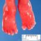 Small first toe in trisomy 18