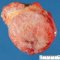 Colonic GIST (section)