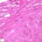Apoptotic epithelial cell in esophageal GVHD
