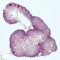 Obstructive horseshoe kidney with pyelic dilatation