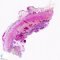 Ileal ulceration in Crohn ileitis