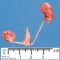 Unilateral renal ectopia (simple ectopia) and renal hypoplasia (Fetus 20 (...)