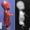 Thanatophoric dysplasia